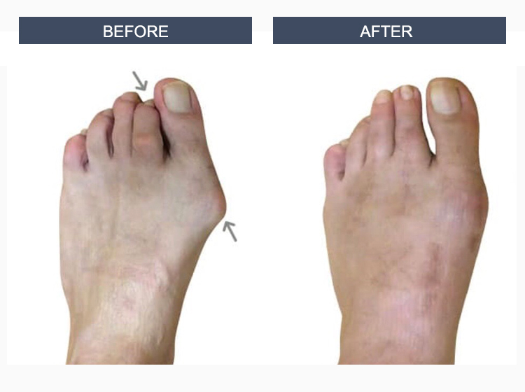 Bunion Surgery Before and After Photos