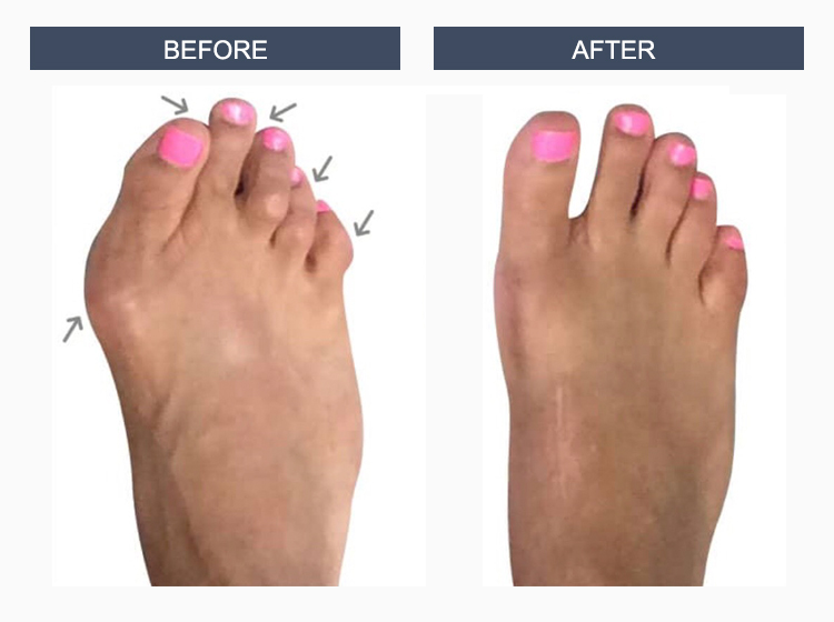 Bunion Surgery Before and After