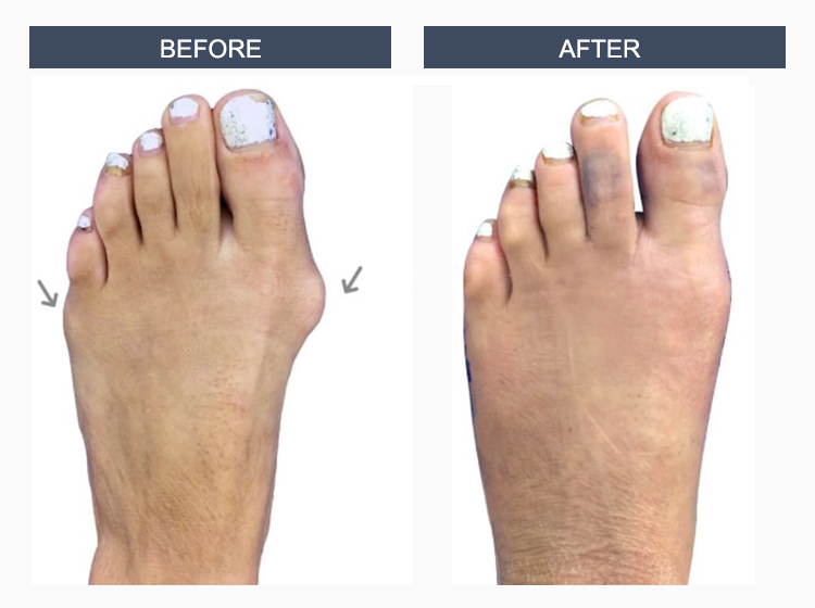 Bunion Surgery