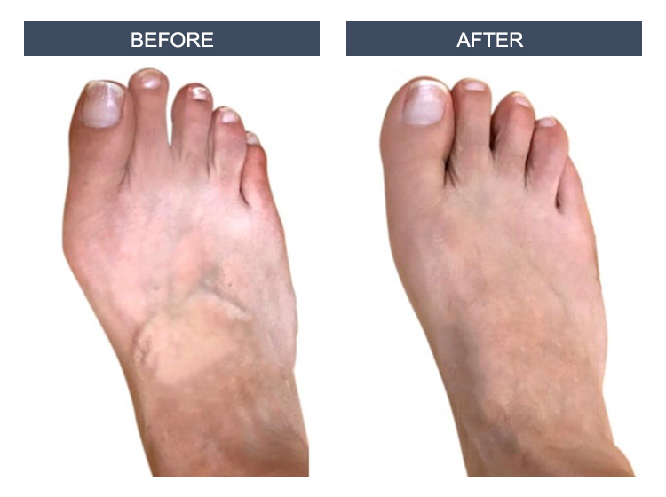 Bunion Surgery Image