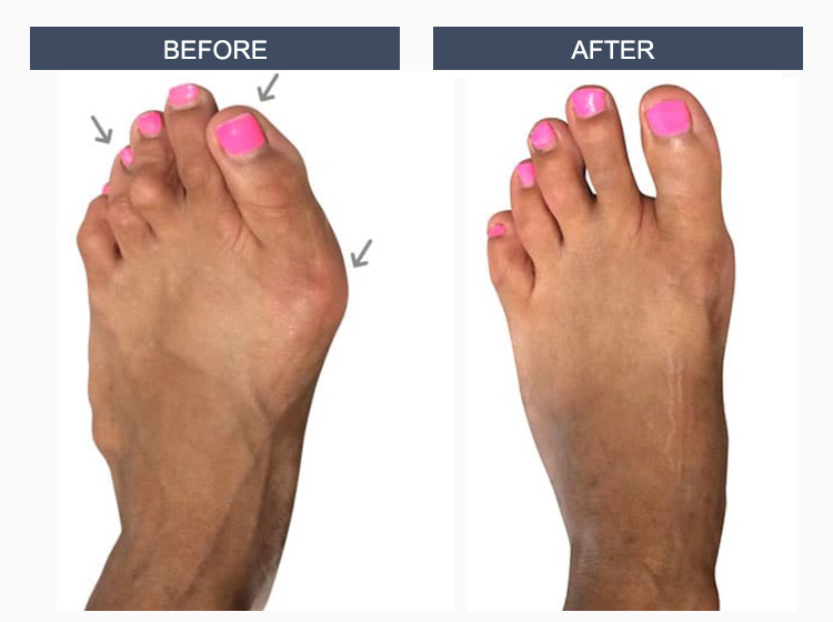 Bunion Surgery