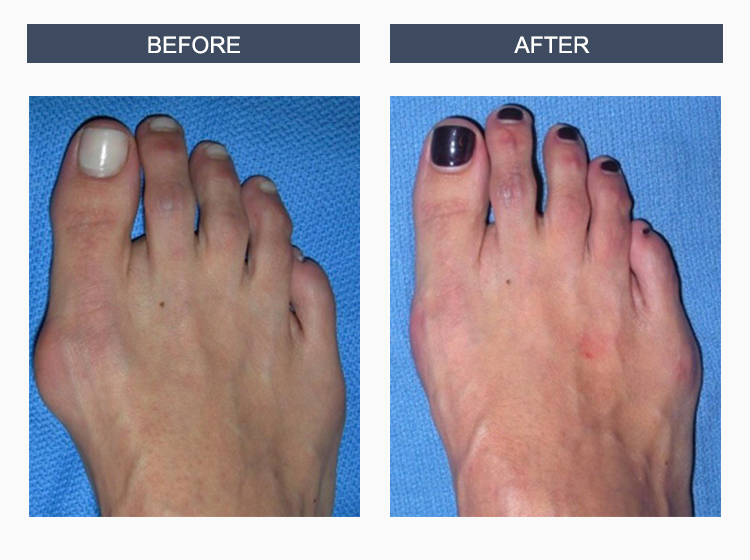 Bunion Surgery